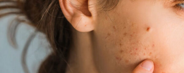 Problemes d-acne