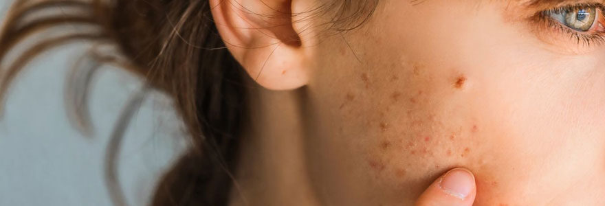 Problemes d-acne